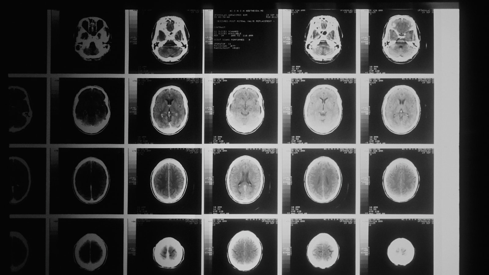 A grid of MRI scan images of a human brain